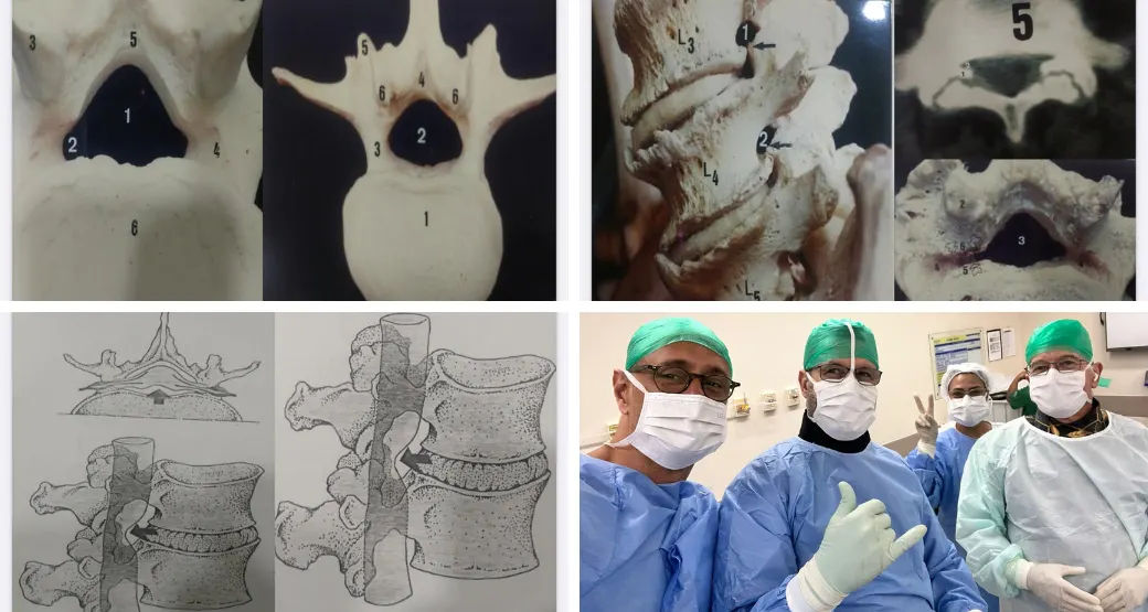 Endoscopia da coluna é um tratamento indicado para estenose degenerativa?
