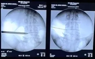 Endoscopia da Coluna Lombar: cirurgia minimamente invasiva e menos agressiva para o corpo