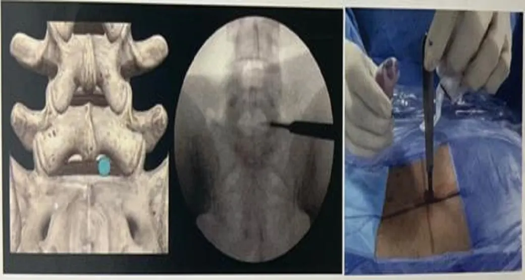 Endoscopia da Coluna Lombar para Hérnia: saiba como é feita a cirurgia