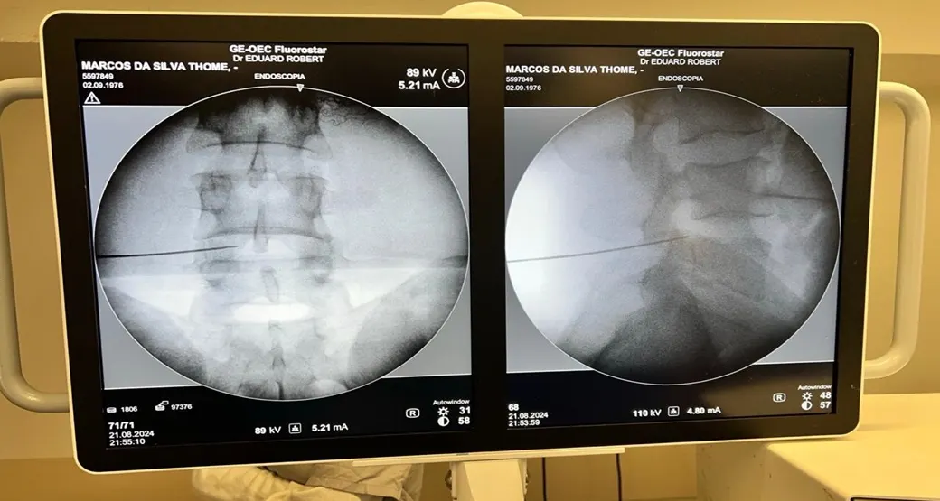 Endoscopia de coluna para retirada da hérnia discal