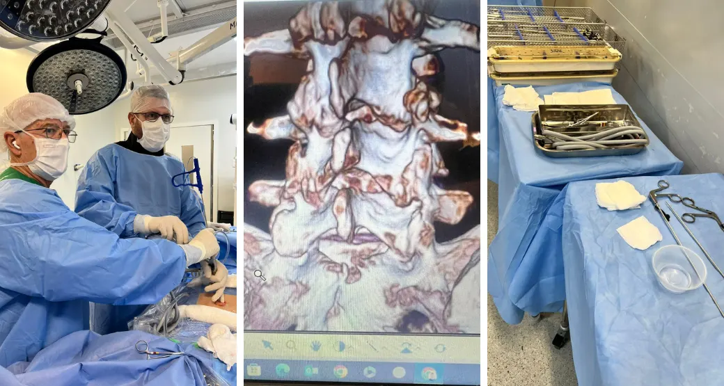 Endoscopia interlaminar descomprime o canal vertebral e remove hérnias discais