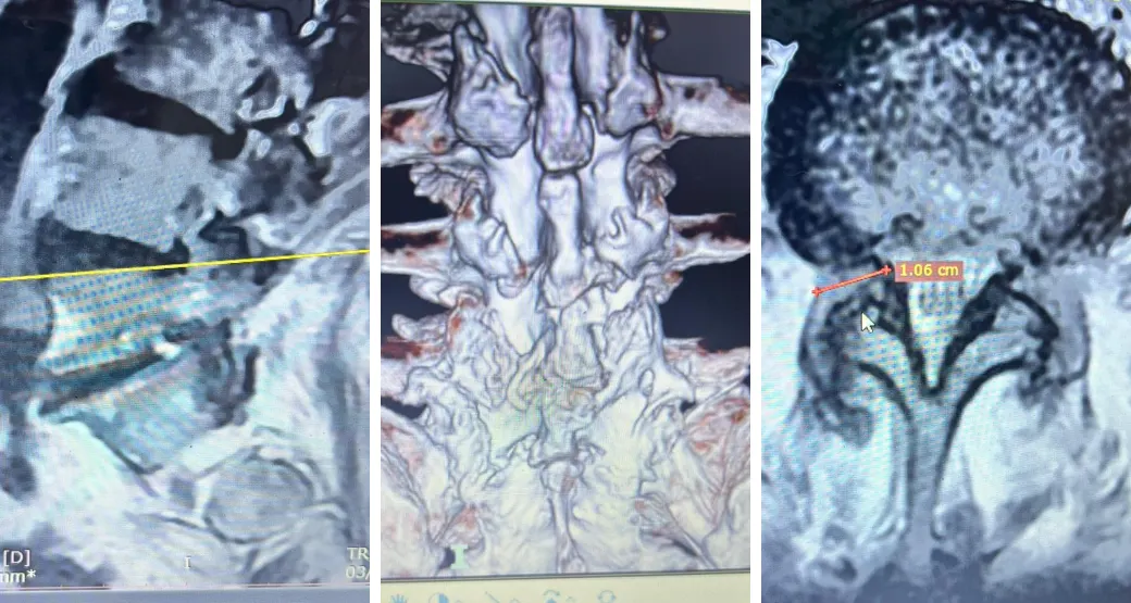 Endoscopia interlaminar: veio para ficar?