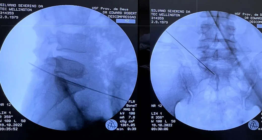 Endoscopia Lombar bem-sucedida precisa de muita técnica, bom instrumental cirúrgico e treinamento da equipe