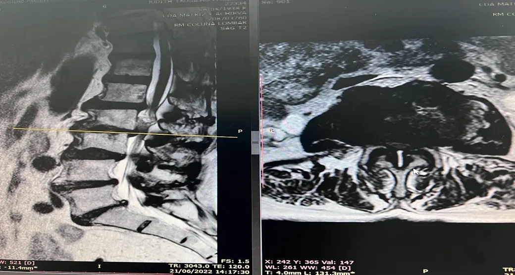 Endoscopia na Coluna Lombar: um caso desafiador
