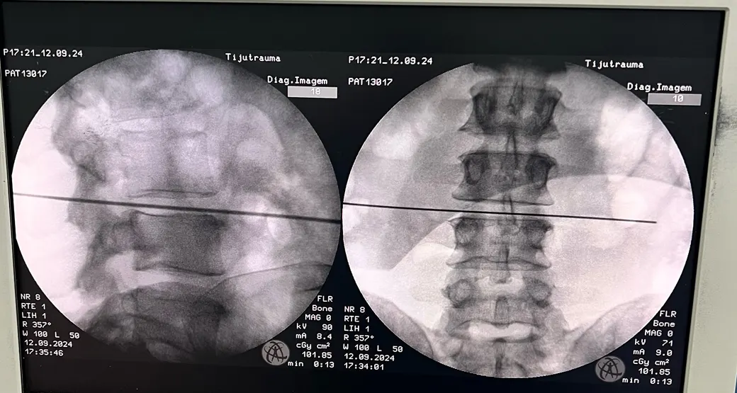 Endoscopia por acesso transforaminal retira hérnia de disco vertebral?