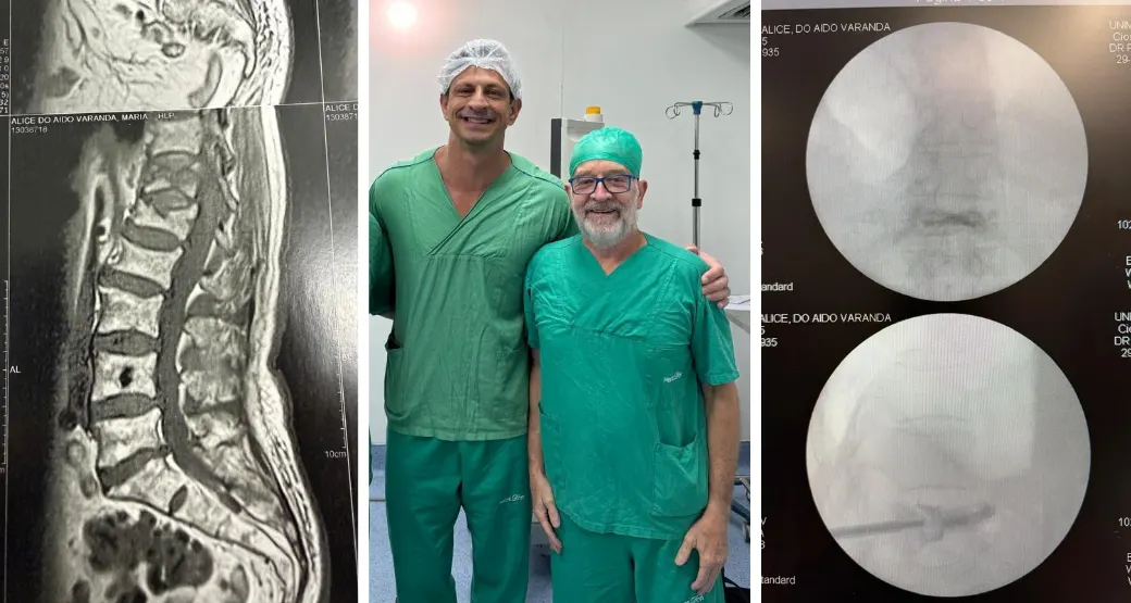 Estabilização vertebral: Cifoplastia devolve sustentação a coluna