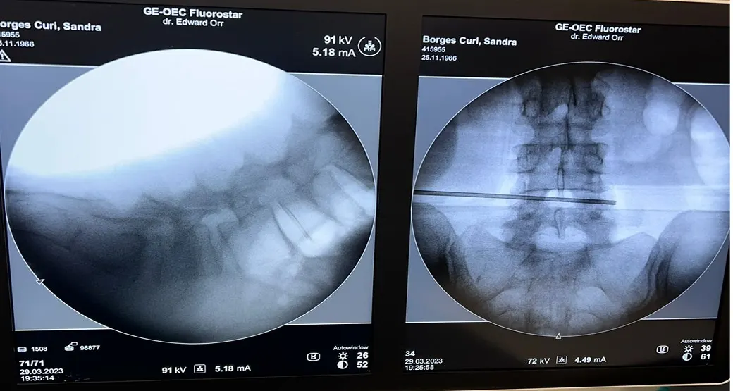 Estenose do canal vertebral por Artropatia, doença na articulação, precisa de cirurgia?