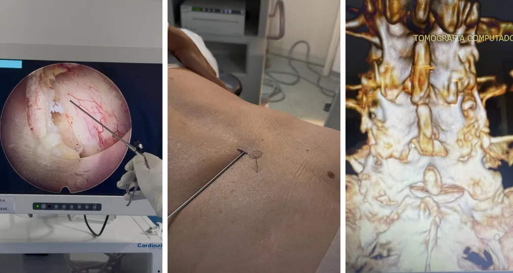 Estenose do Canal Vertebral: Saiba como foi a cirurgia de uma paciente da Orto Center