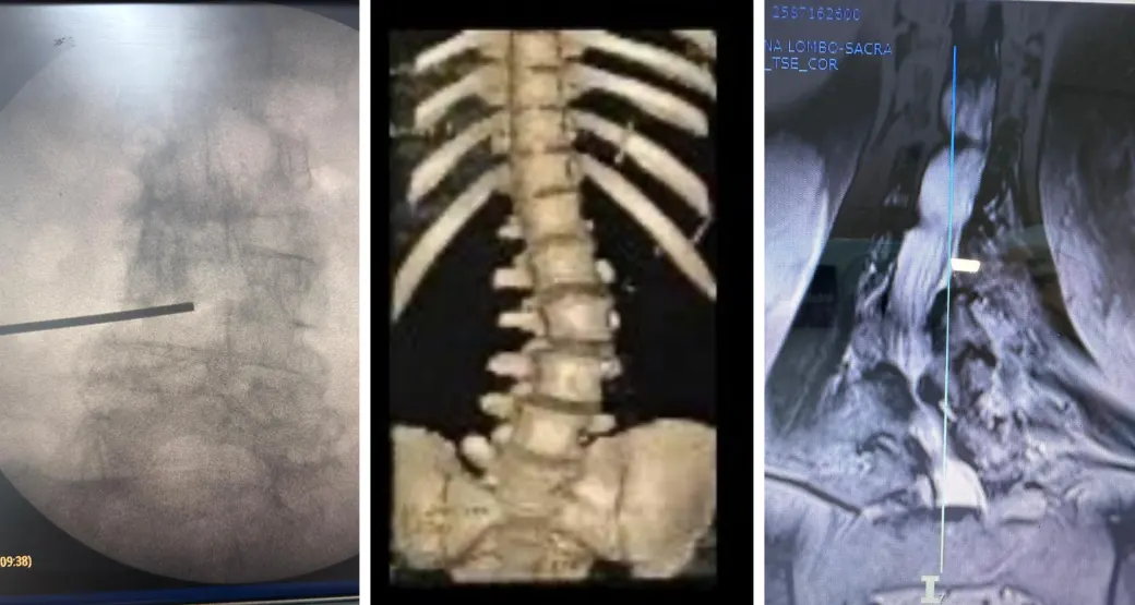 Estenose grave do canal vertebral: um desafio cirúrgico. Ficou curioso?