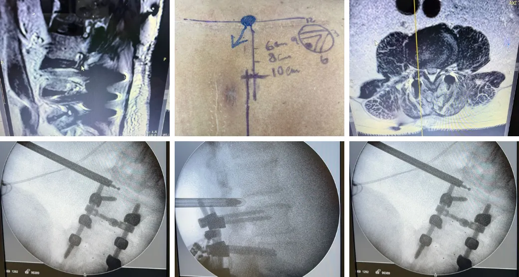Estenose lombar: O que esperar após a cirurgia e como se recuperar