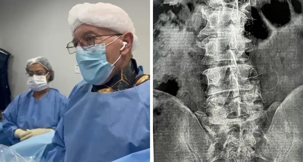 Estenose lombar: quando a cirurgia endoscópica é indicada