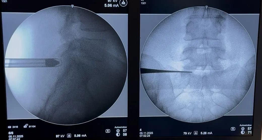 Hérnia de disco extrusa: Saiba como tratar dessa condição séria da coluna vertebral