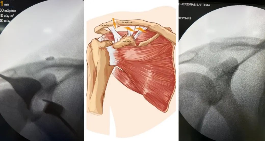 Luxação acromioclavicular com dispositivo TightRope: Quando o tratamento é cirúrgico
