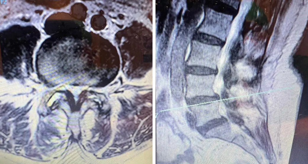 O que é estenose do canal vertebral? A cirurgia endoscópica é indicada para este caso?