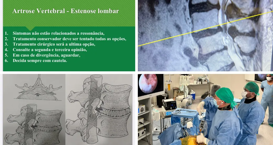 O que é estenose lombar central e lateral? O tratamento é cirúrgico?