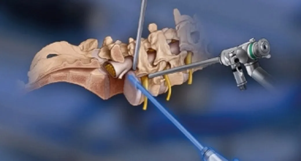 O que mudou com a Endoscopia Lombar para o tratamento de hérnias de disco?