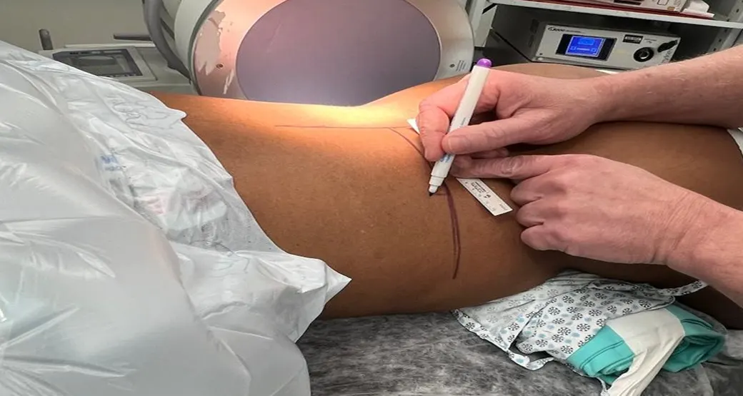 O que são hérnias de migração inferior? Cuidado com elas!