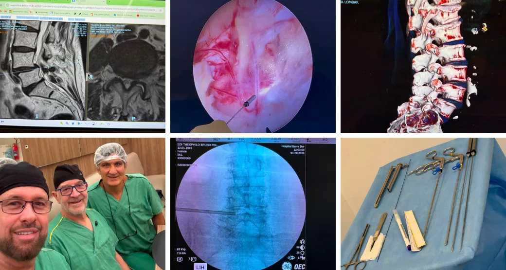 OrtoCenter: referência em cirurgia endoscópica da coluna