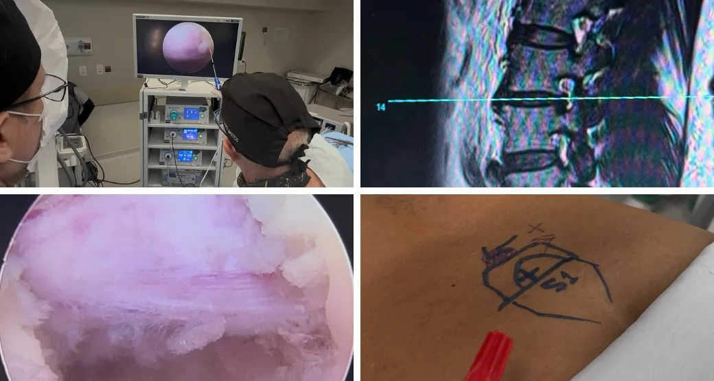 Paciente idoso com várias hérnias na lombar. Solução? Cirurgia endoscópica