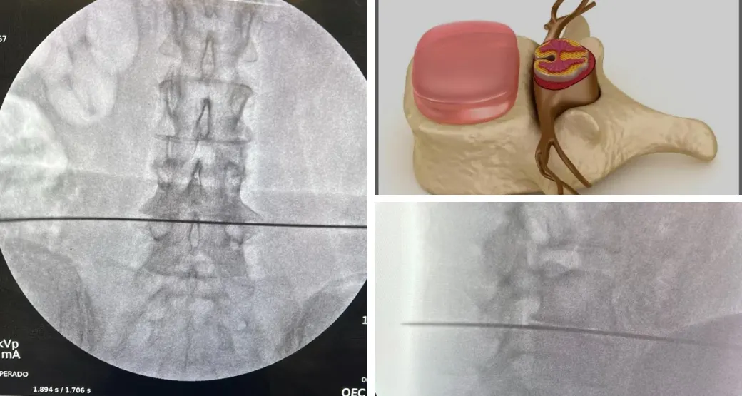 Por que a escolha pelo acesso via transforaminal na cirurgia de coluna lombar?
