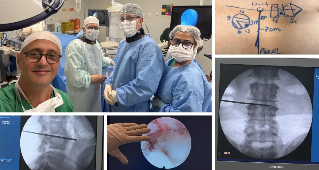 Por que fazer uma cirurgia grande se a endoscopia resolve duas hérnias? Caso real, 58 anos