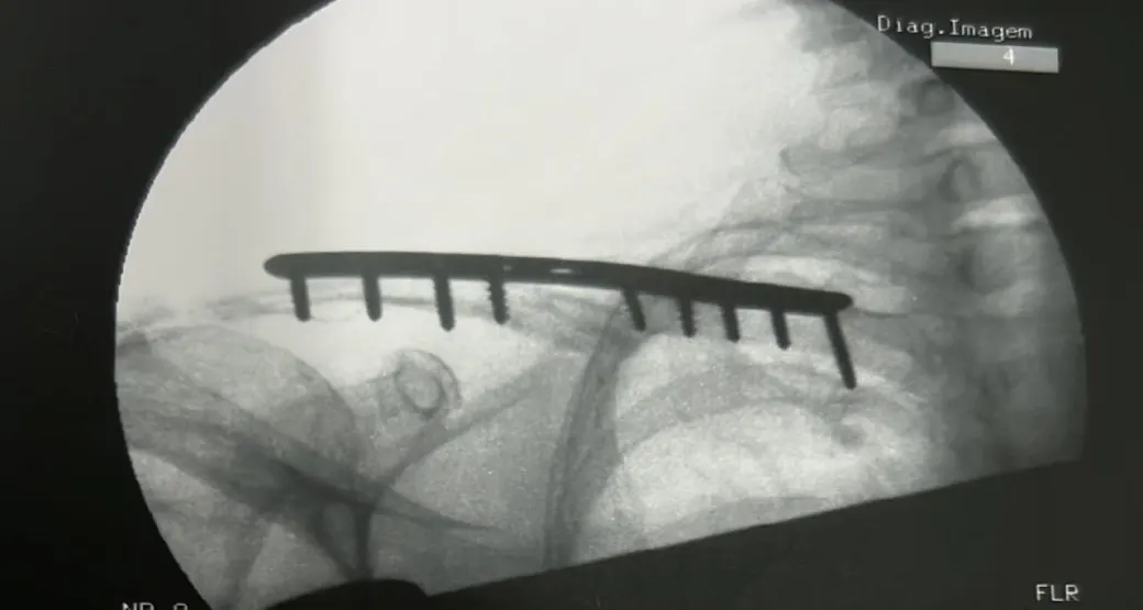 Pseudoartrose de fratura é cirúrgica?
