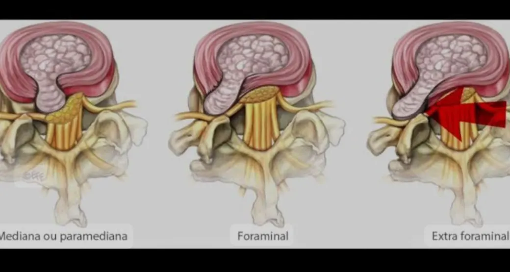 Quando ocorre a hérnia de disco extraforaminal? É tratada com cirurgia endoscópica?