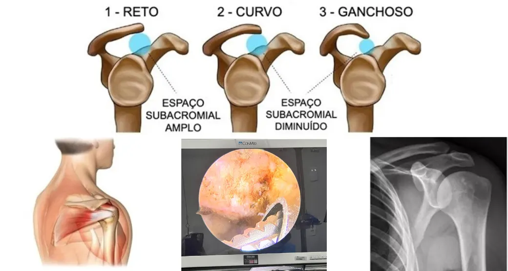 Quando ocorre a síndrome acromial, mais conhecida como síndrome do impacto do ombro?