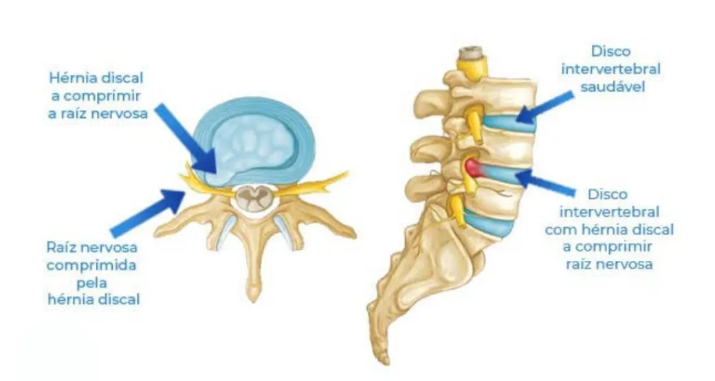 Quando ocorre compressão das raízes nervosas da coluna vertebral? A cirurgia endoscópica é necessária?