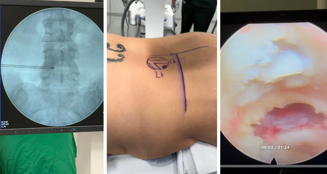 Raiz L4 presa por hérnia volumosa. Endoscopia transforaminal liberou o nervo