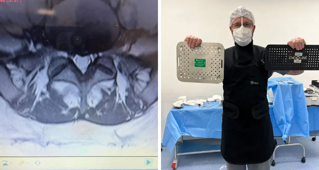 Retirada da hérnia de disco lombar: Terei que realizar uma cirurgia?