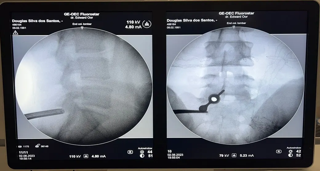 Revisão de Endoscopia lombar