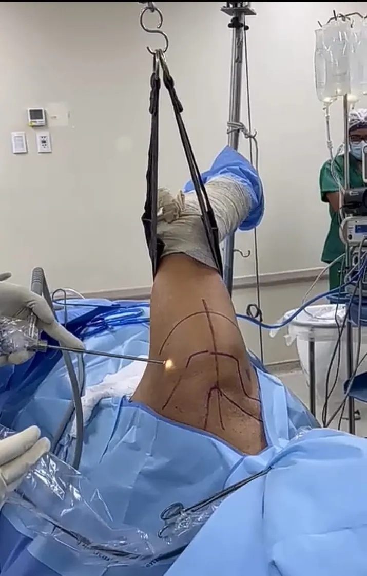 Saiba como tratar a Síndrome Acromial com lesão de manguito