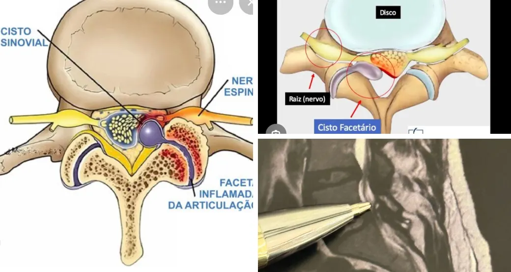 Superando limites: cirurgia endoscópica ajuda paciente com paralisia cerebral