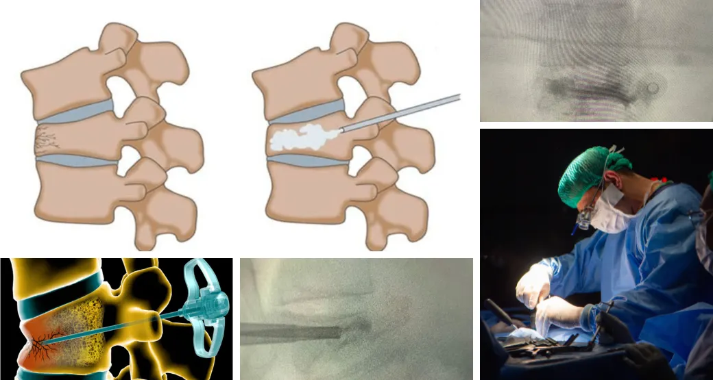 Tratamento minimamente invasivo para fratura por Osteoporose na coluna