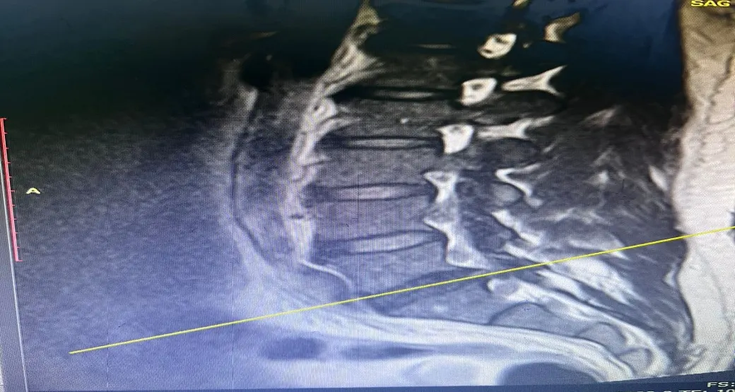 Você já ouviu falar em Endoscopia na Coluna por abordagem interlaminar?