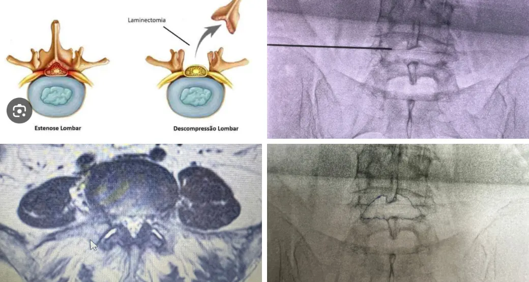 Você sofre de dor lombar ou ciática? A Endoscopia de coluna é uma alternativa segura para o tratamento?