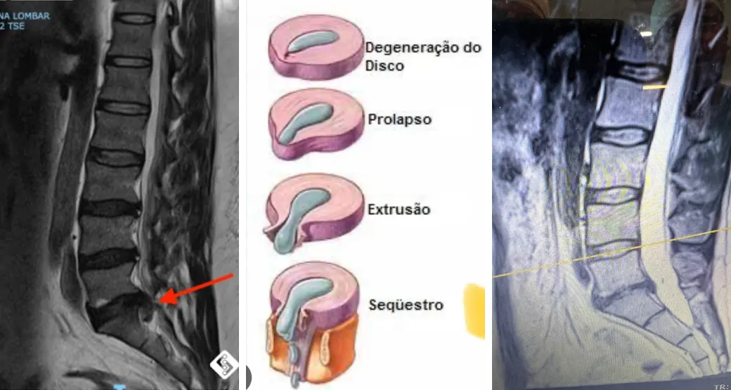 Você sofre de hérnia discal lombar? A doença é grave?